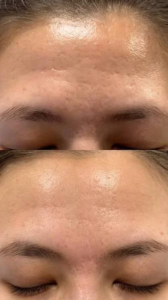 Пошук моделей на Post-acne
