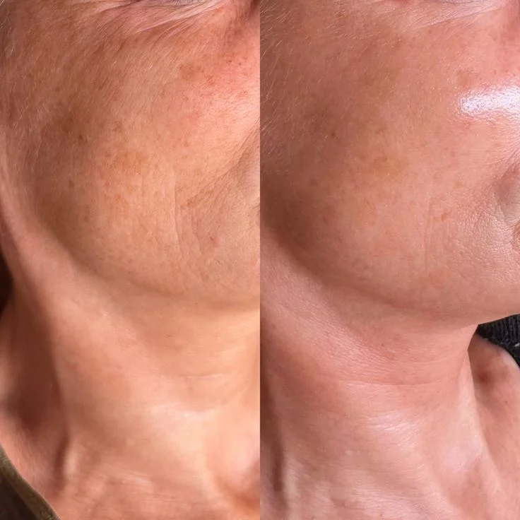 Пошук моделей на мікронідлінг glow skin